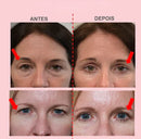 Levanta Pálpebras Caídas - Palp Lifting | Você mais bela o dia todo | 600 Tiras